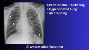 bronchiolitis x-ray fetures