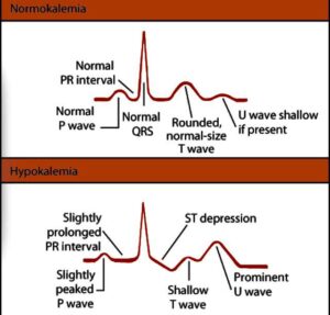 ecg change in hypokalemia