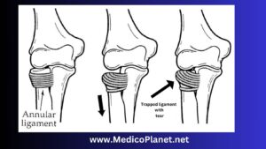 pulled elbow pathophysiology